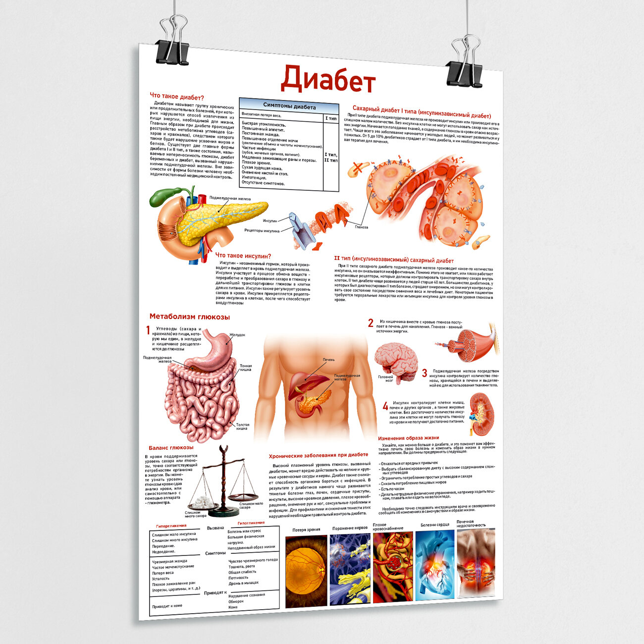 Обучающий медицинский плакат "Диабет" / ламинированный / А-1 (84x60 см.)