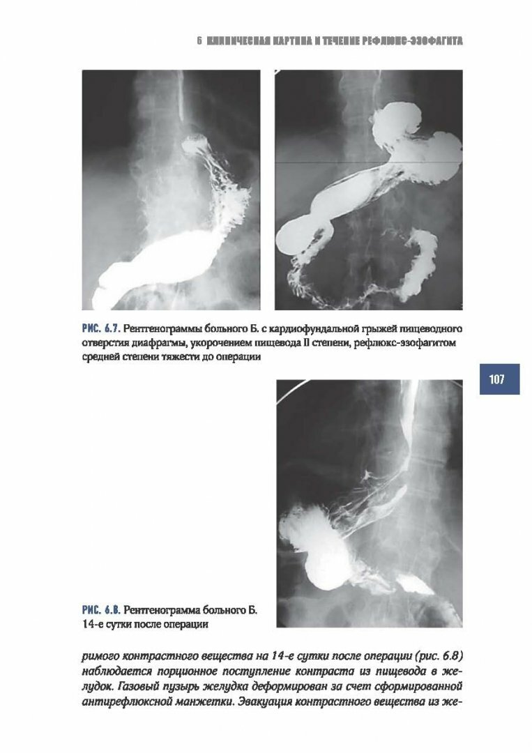 Рефлюкс-эзофагит (Черноусов Александр Федорович, Хоробрых Татьяна Витальевна, Ветшев Федор Петрович) - фото №3
