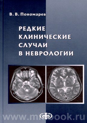 Редкие клинические случаи в неврологии (случаи из практики). Руководство для врачей - фото №3
