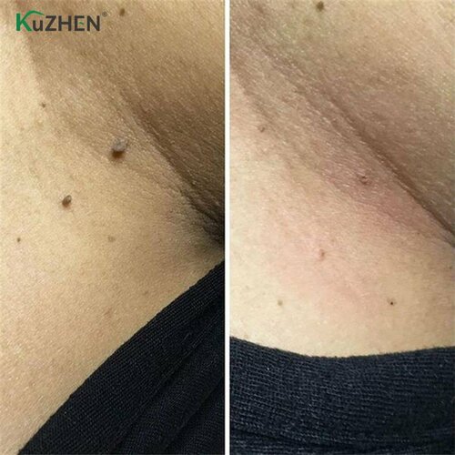 Мгновенное удаление родинок папиллом инструментов для ремонта мозолей на ногах натуральная бактериостатическая жидкость 10 мл средство для удаления кожных меток лечение генитальных бородавок 1260₽