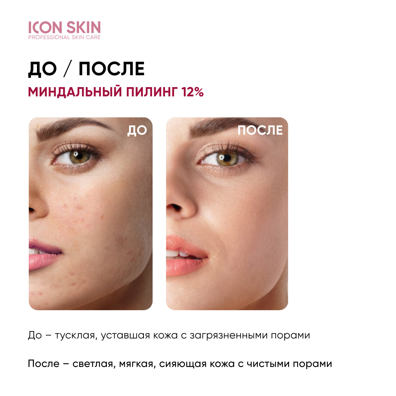 Icon Skin Миндальная смарт-пилинг система 12%, 30 мл (Icon Skin, ) - фото №5