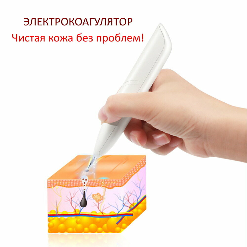 Прибор для удаления бородавок и папиллом (Mole Freckle Removal Pen ).