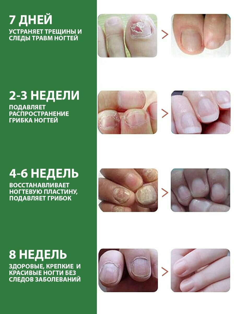 Изображение EELHOE Средство для ногтей, профилактика и лечение от грибка онихомикоза на руках и ногах, при отслоении, ломкости, для роста ногтевой пластины, 20 мл