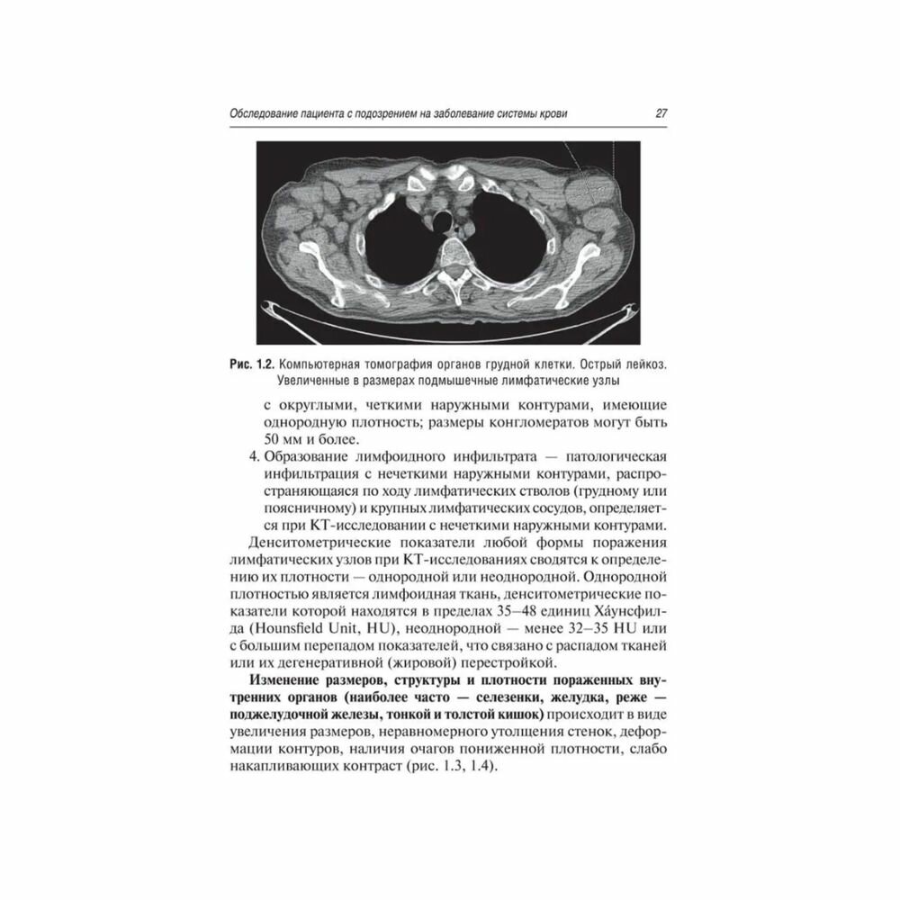 Лучевая диагностика при заболеваниях системы крови - фото №11