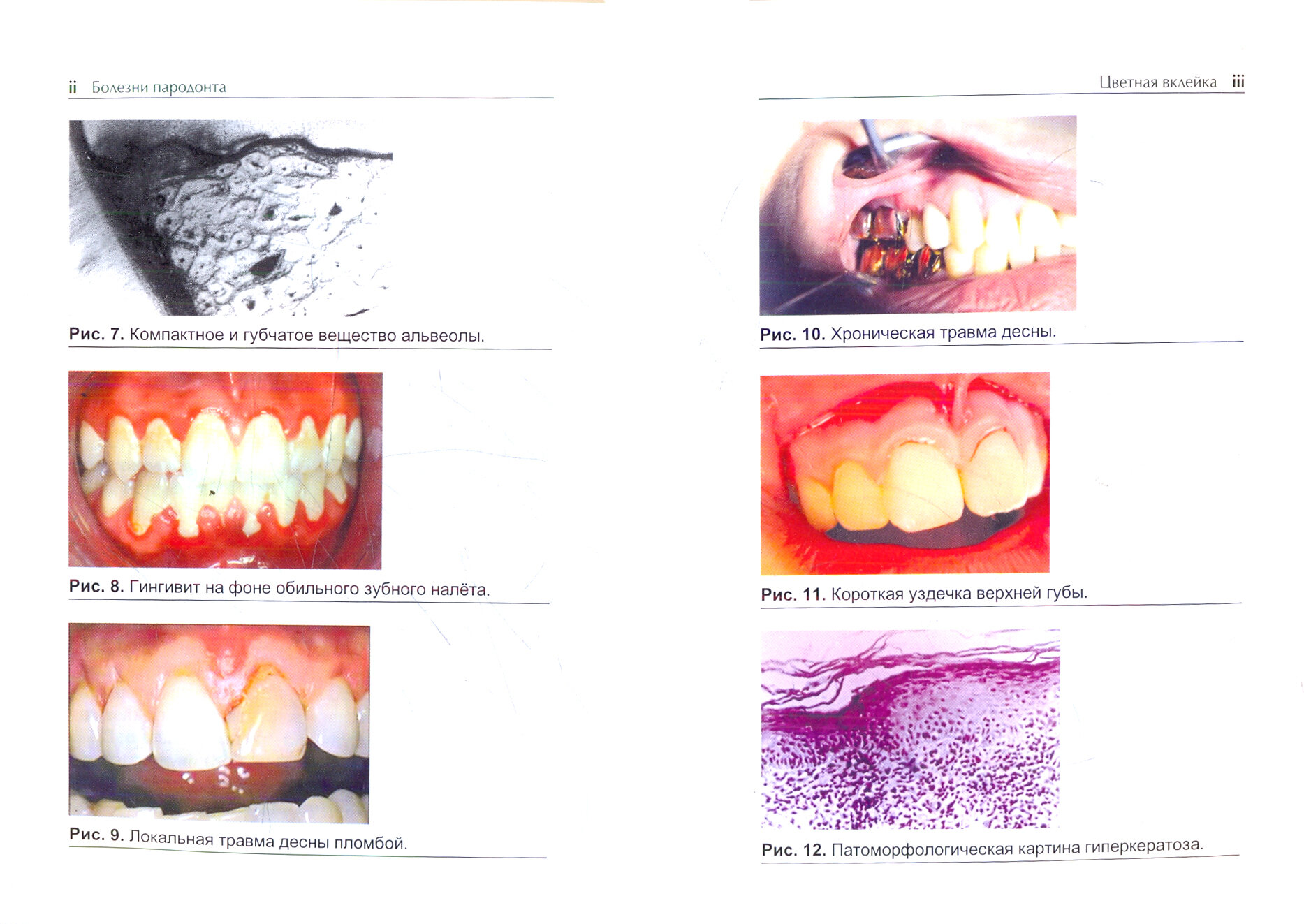 Болезни пародонта (Луцкая Ирина Константиновна) - фото №4