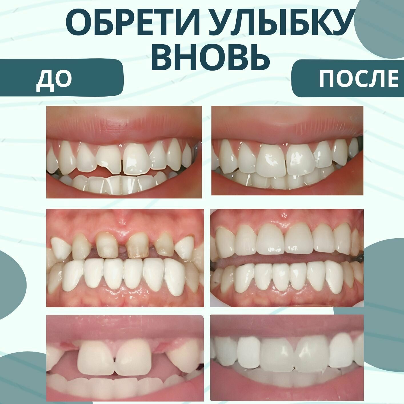 Временная пломба для зуба, самостоятельное изготовление накладных и вставных зубов, 20 гр — фото 1
