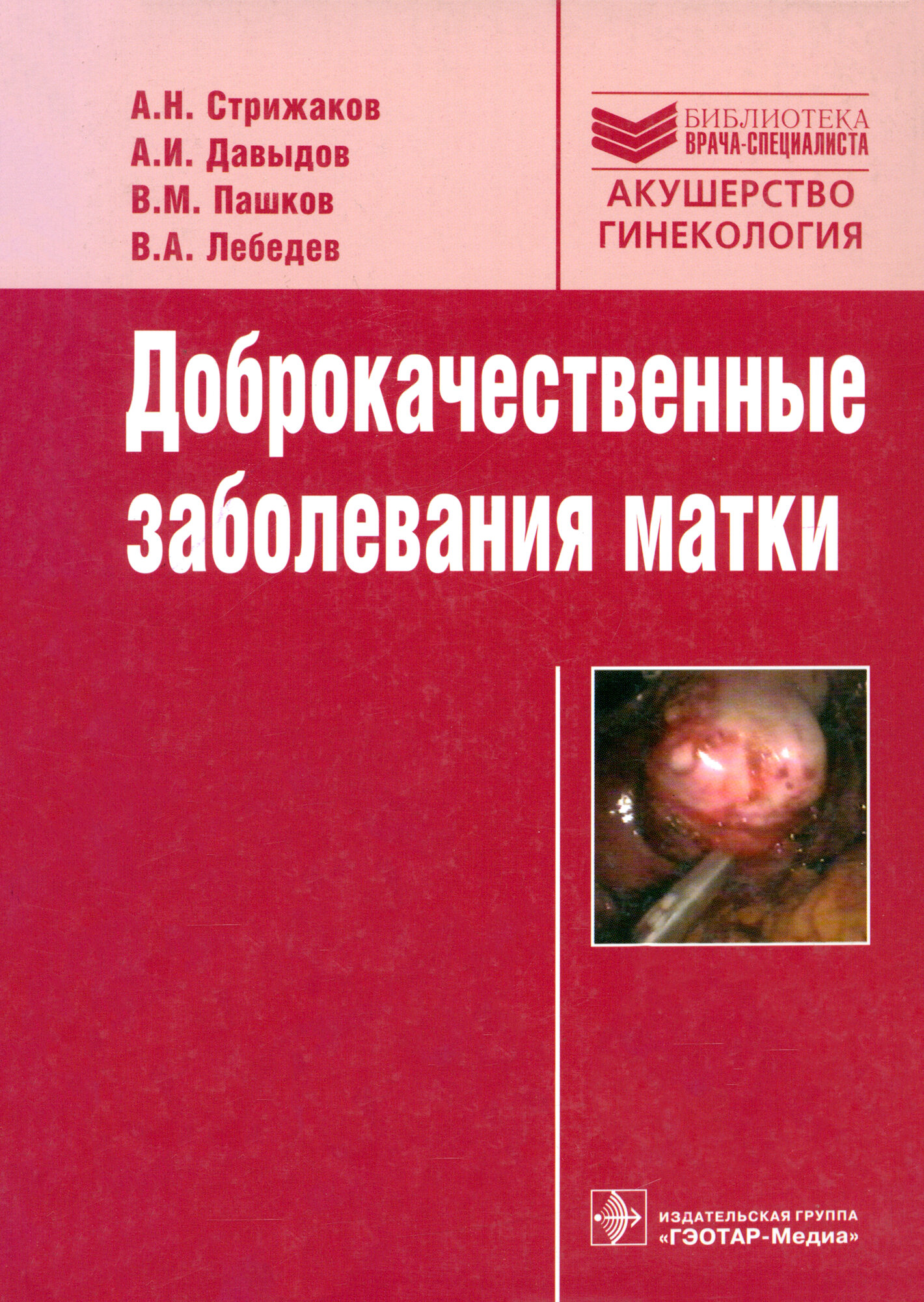 Доброкачественные заболевания матки - фото №6