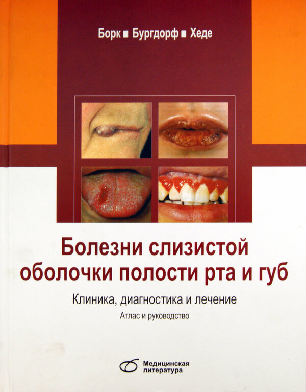 Болезни слизистой оболочки полости рта и губ. Клиника, диагностика и лечение