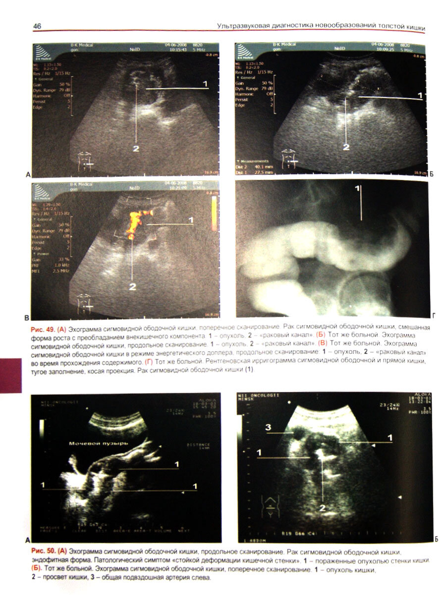 Ультразвуковая диагностика новообразований толстой кишки - фото №2