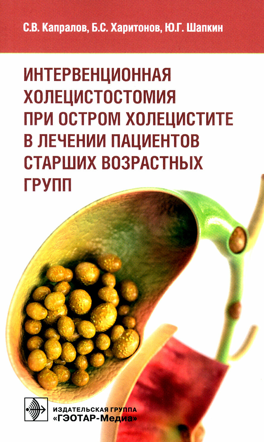 Интервенционная холецистостомия при остром холецистите в лечении пациентов старших возрастных групп - фото №5