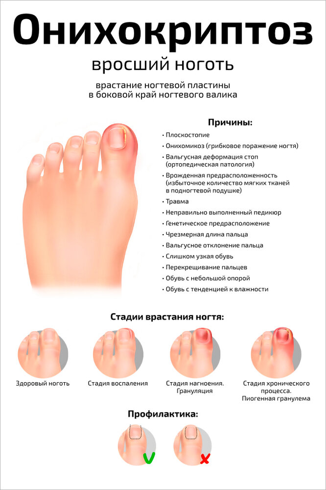 Плакат Квинг Онихокриптоз: вросший ноготь ламинированный 457×610 мм ≈ (А2)