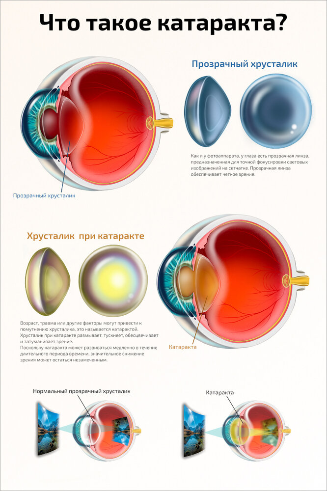 Плакат Квинг Что такое катаракта? ламинированный 457×610 мм ≈ (А2)