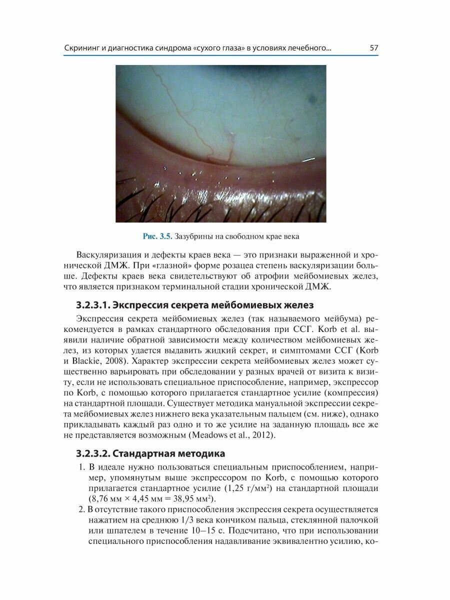 Синдром "сухого глаза". Практический подход - фото №14