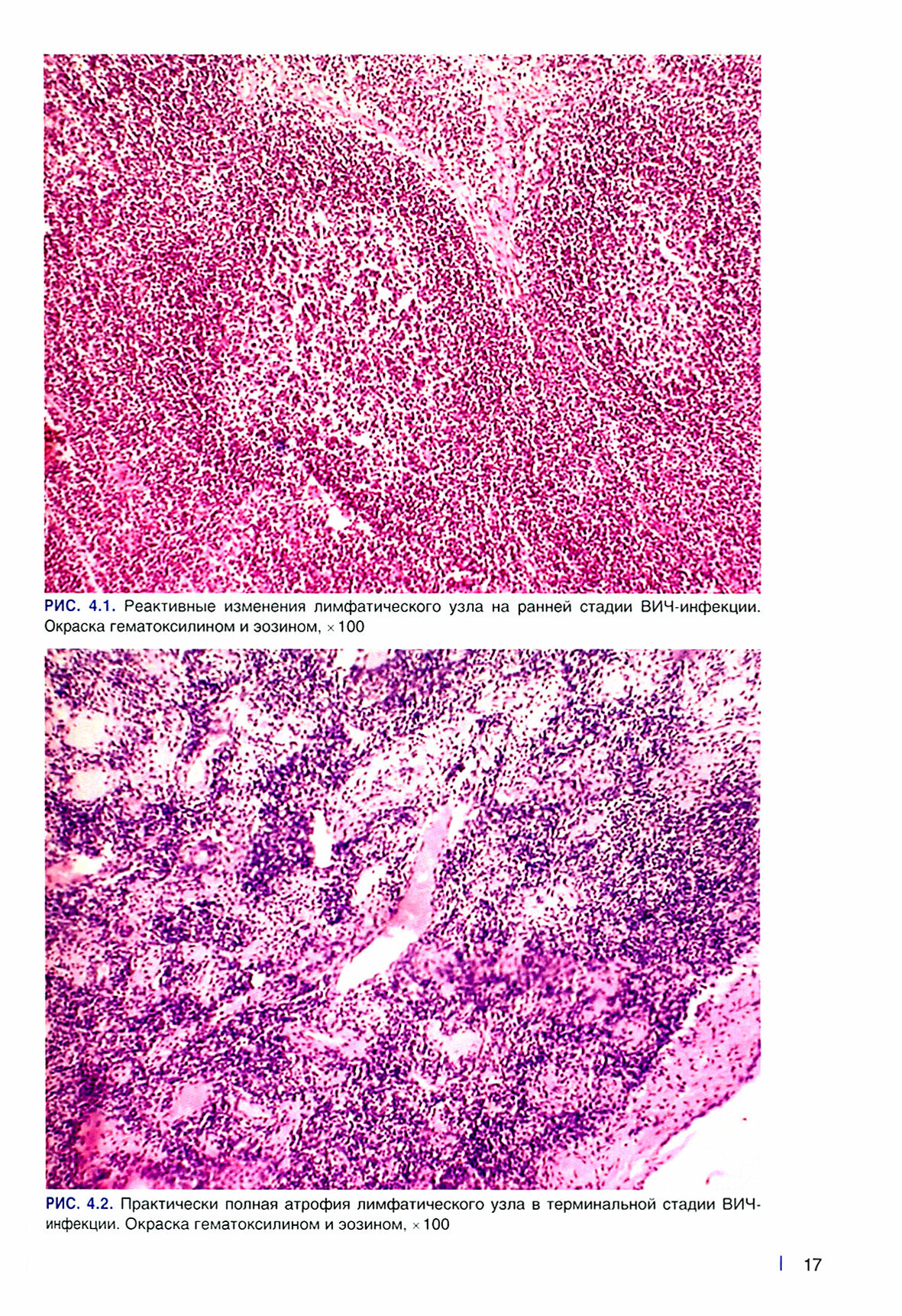Посмертная и прижизненная патолого-анатомическая диагностика болезни, вызванной ВИЧ (ВИЧ-инфекции) - фото №3