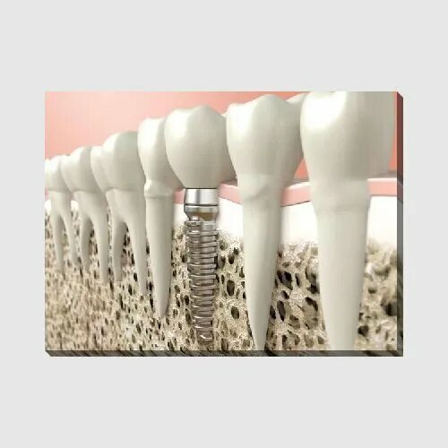 Картина на холсте Зубной имплант, 40*30 см