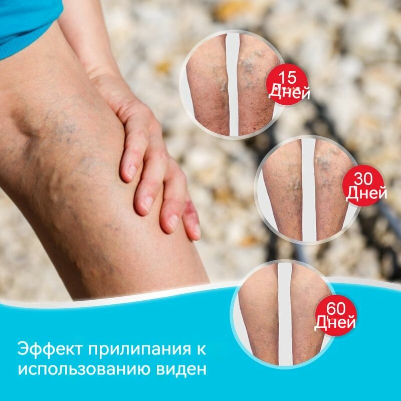 Пластыри от варикозного расширения вен и васкулита  От венозной недостаточности  Обезболивающий Китай