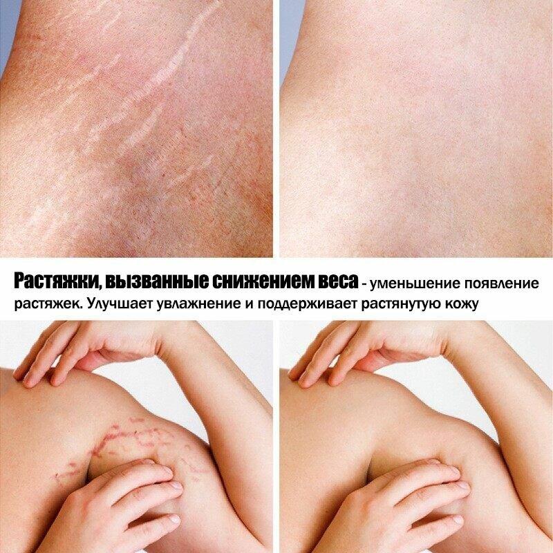 Лекарства От Растяжек Крем от растяжек 60 мл, восстанавливает эластичность кожи, для ног и живота, питает кожу.