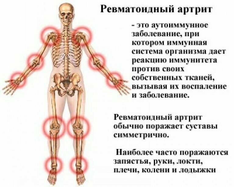 Изображение Шаллаки Шри Ганга при ревматизме, артрозе, ревматоидный артрит, остеохондроз Shallaki Shri Ganga 120 таб.