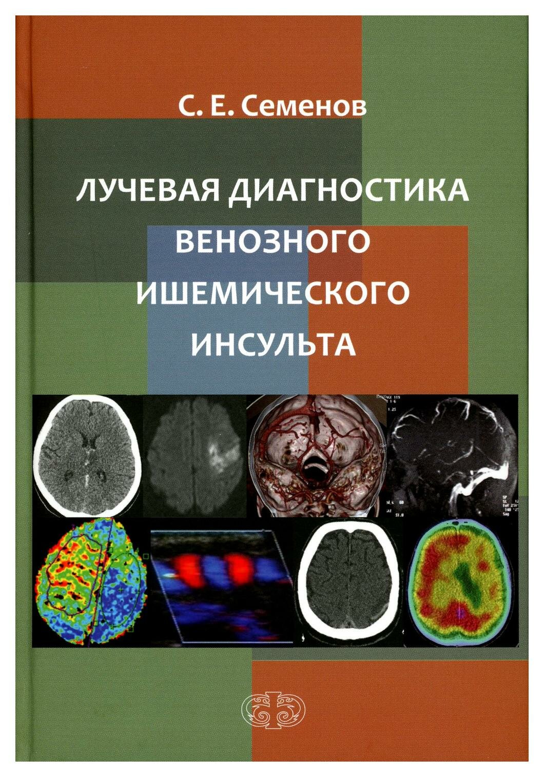 Лучевая диагностика венозного ишемического инсульта - фото №2