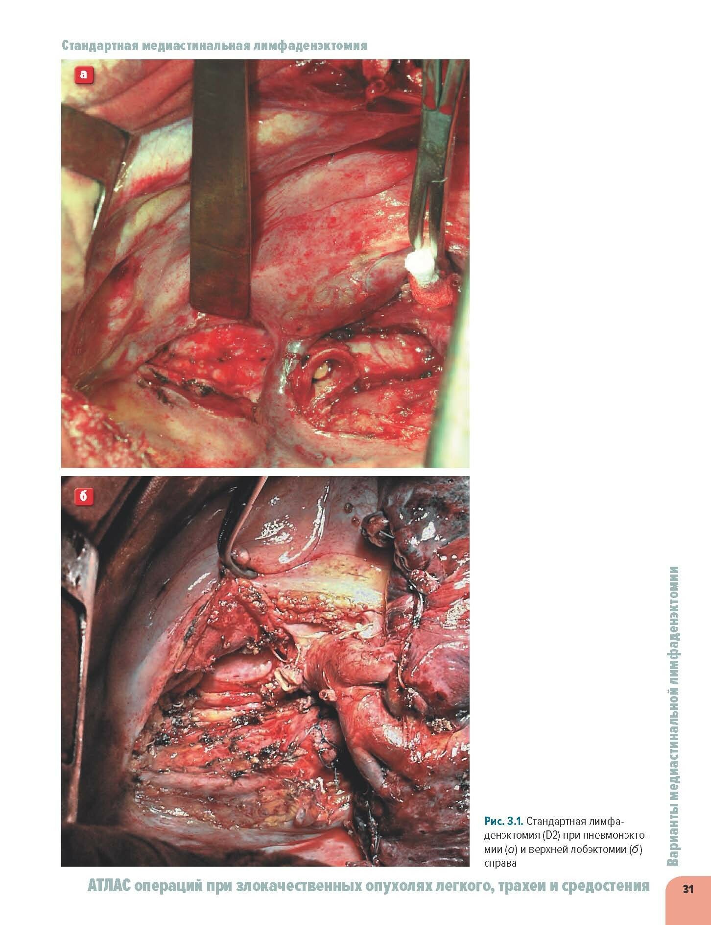 Атлас операций при злокачественных опухолях легкого, трахеи и средостения - фото №15