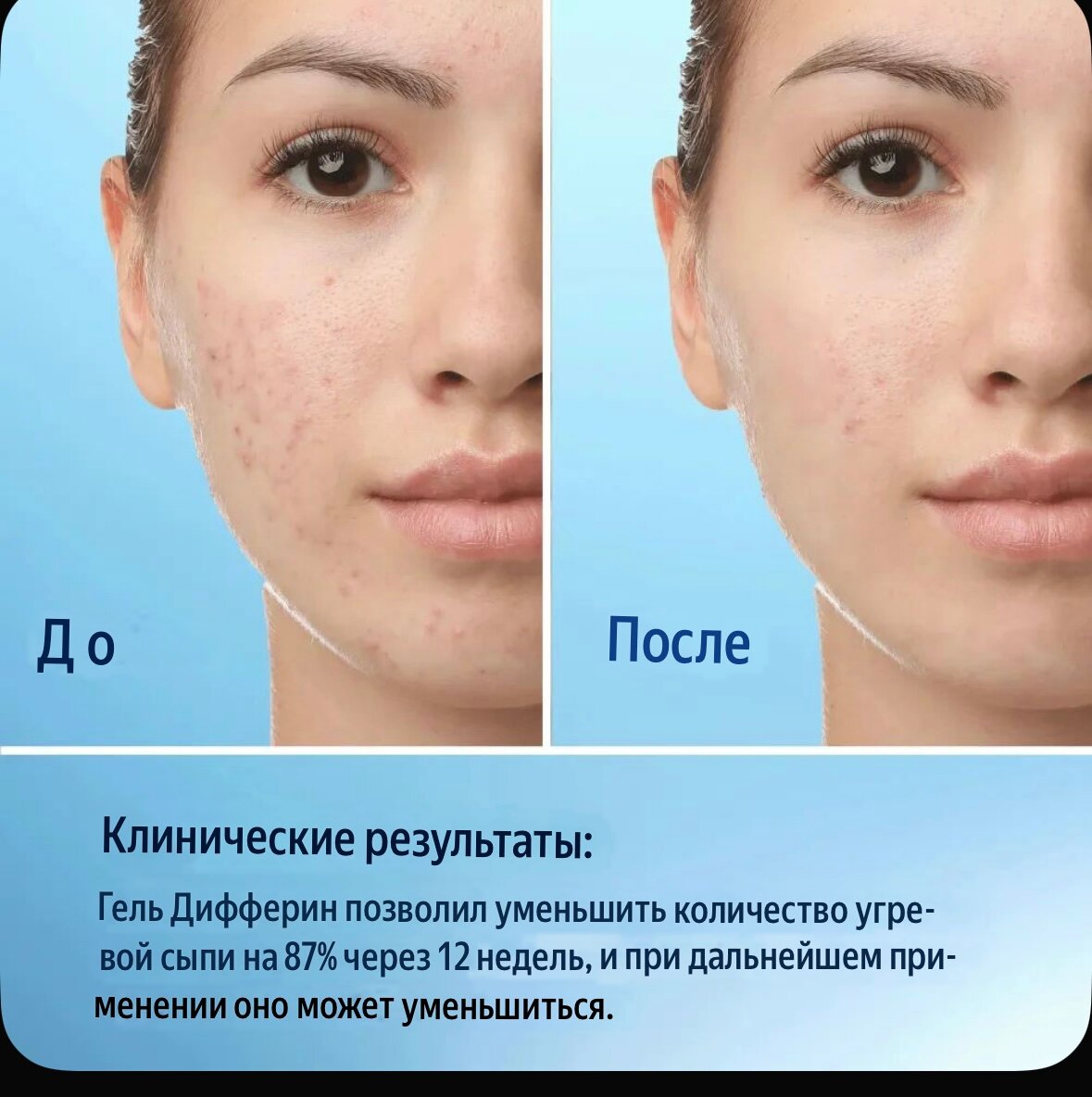 Гель от прыщей 15 гр — фото 1