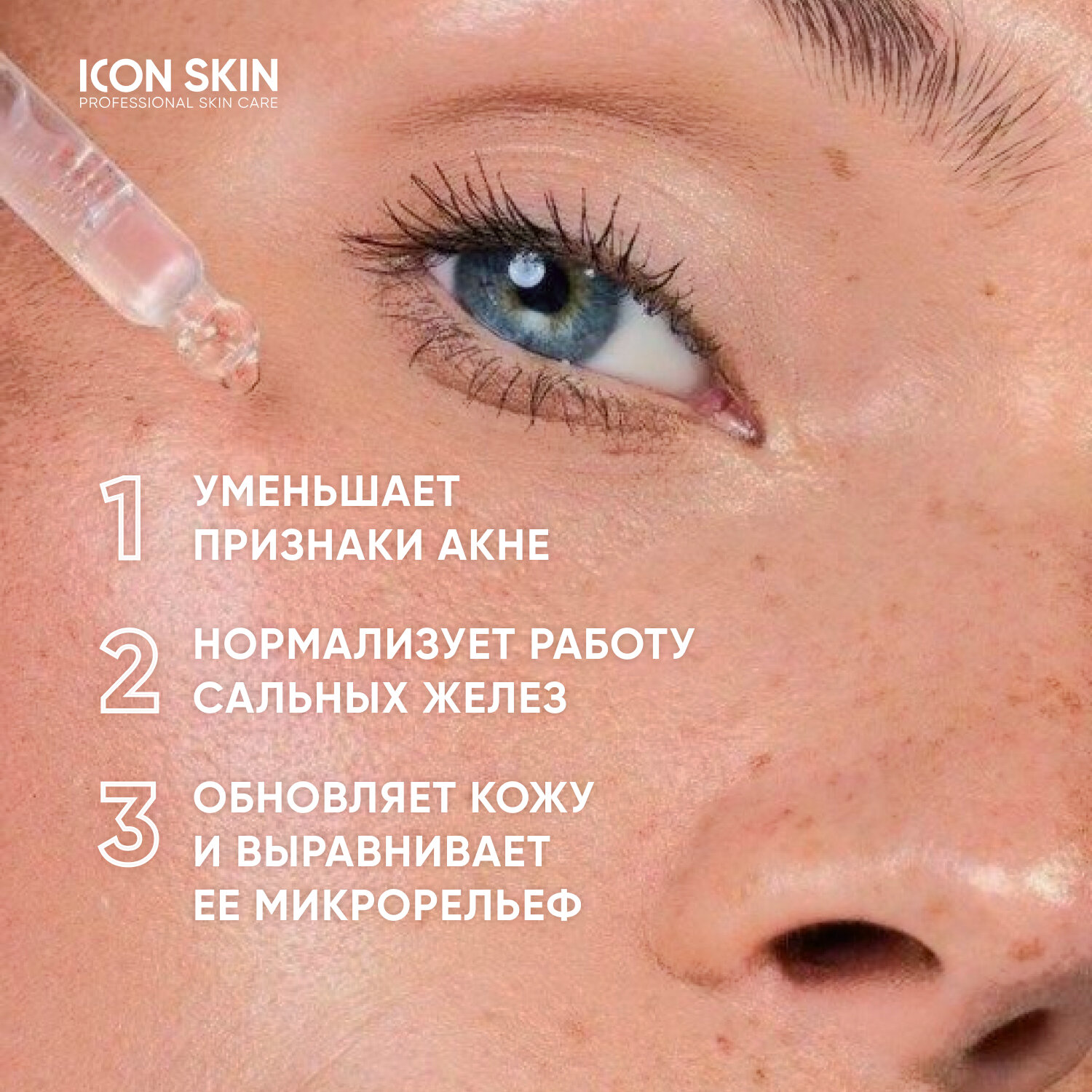 ICON SKIN / 18% Смарт пилинг-система для проблемной кожи / 18% Anti-acne Smart Peel System, 30 мл.