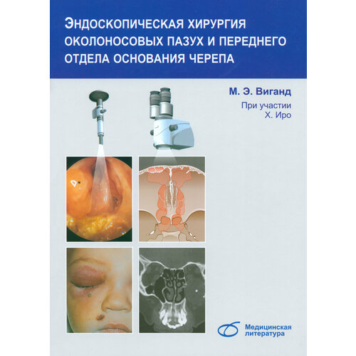 Эндоскопическая хирургия околоносовых пазух и переднего отдела основания черепа | Виганд М. Э.