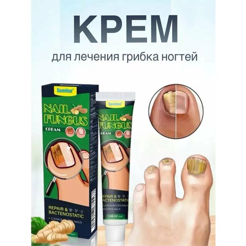 Крем для лечения грибка ногтей xifeishi крем для лечения грибка ногтя онихомикоза