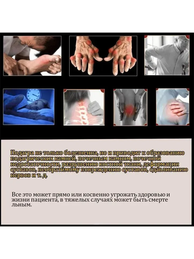 Подагра мазь для лечения артрита вальгусная деформация 55г