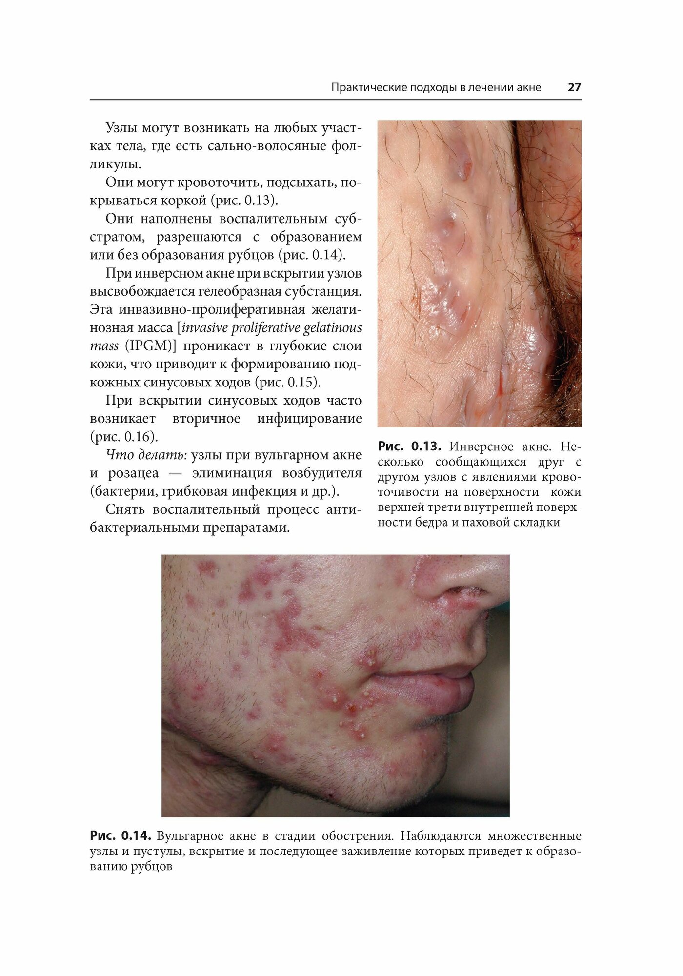 Акне (Дэнби У.Ф., Пер.с англ., Под ред.В.И.Альбановой,Дэнби У.Ф.) - фото №6