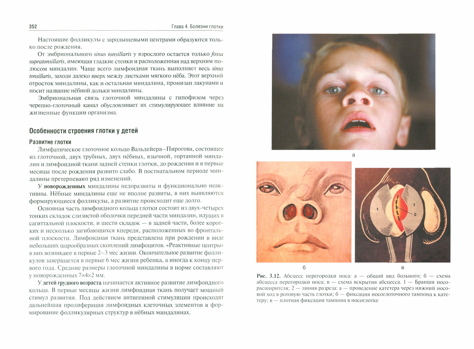 Детская оториноларингология (Богомильский Михаил Рафаилович, Чистякова Валентина Рышардовна) - фото №3