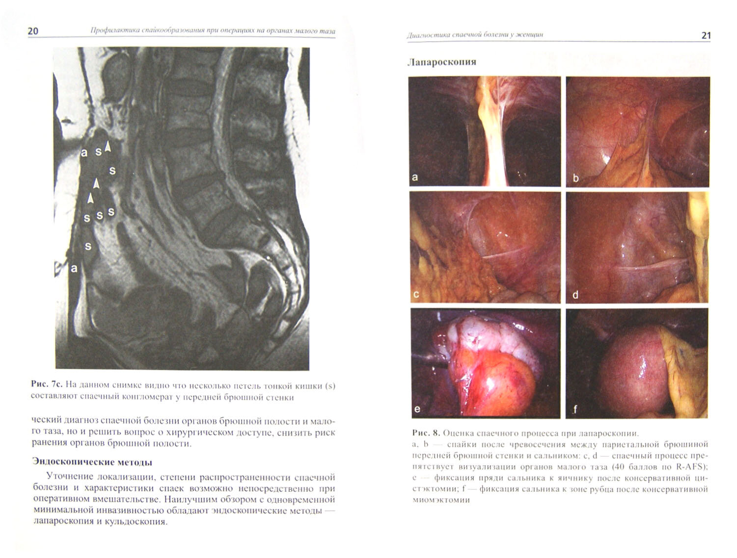 Профилактика спайкообразования при операциях на органах малого таза - фото №2