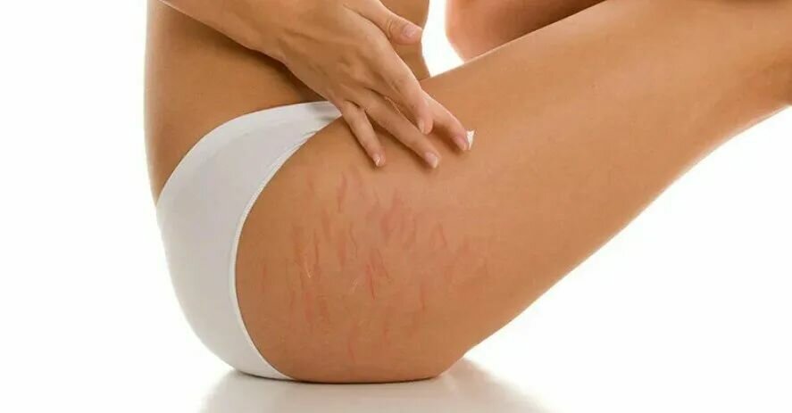 Изображение AROSHA BODY RESCUE STRETCH MARKS Восстанавливающий крем против растяжек