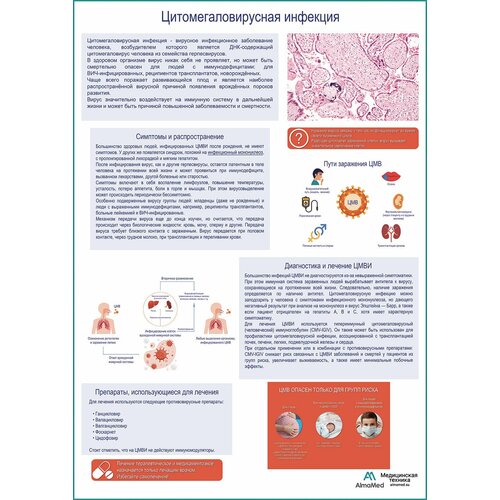 Цитомегаловирусная инфекция, медицинский плакат, матовый холст от 200 г/кв. м, размер A1+