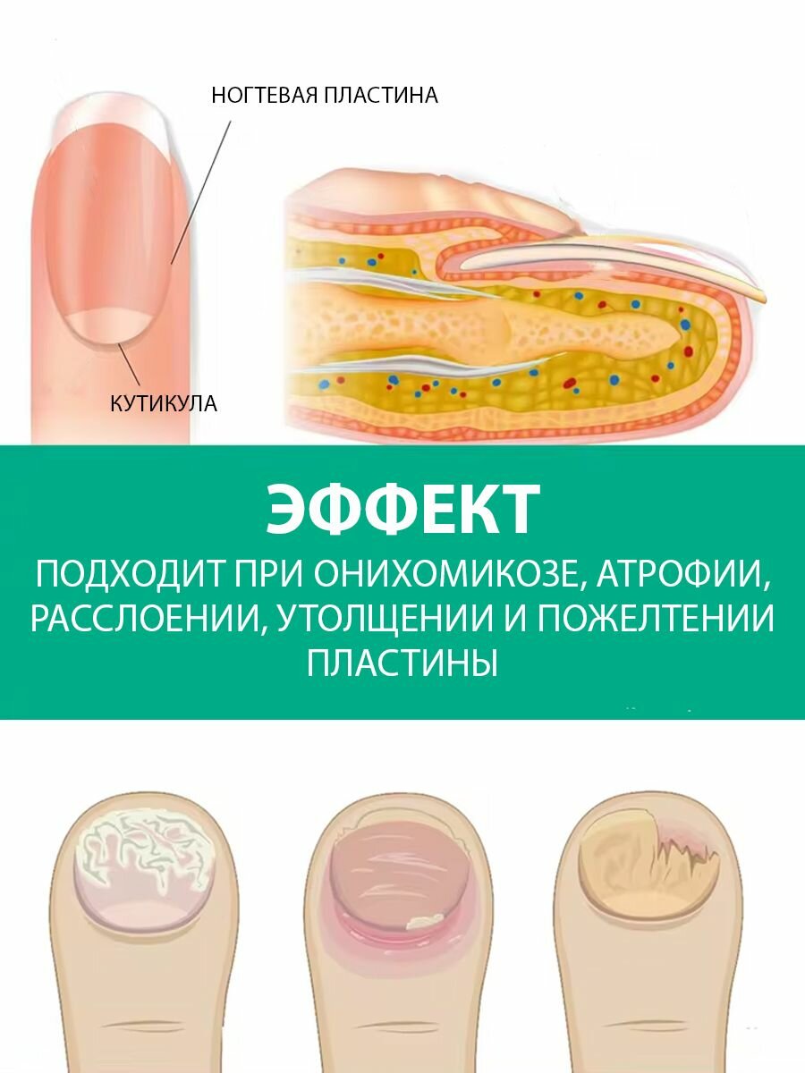 Изображение Мазь от грибка ногтей на руках и ногах, противогрибковое средство для восстановления, мазь для ухода ногтями и кутикулой