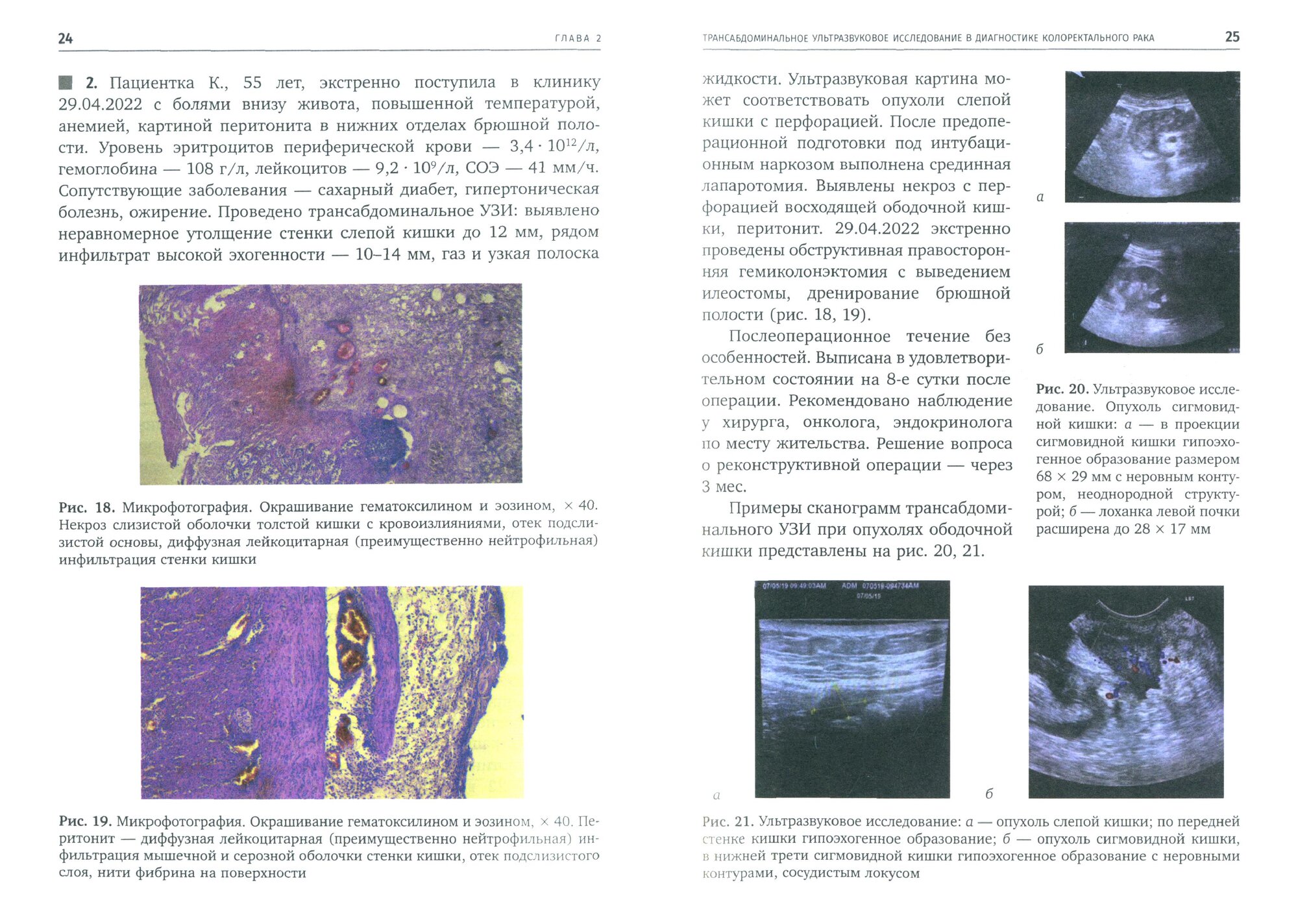 Трансабдоминальное ультразвуковое исследование в диагностике дивертикулярной болезни ободочной кишки - фото №3