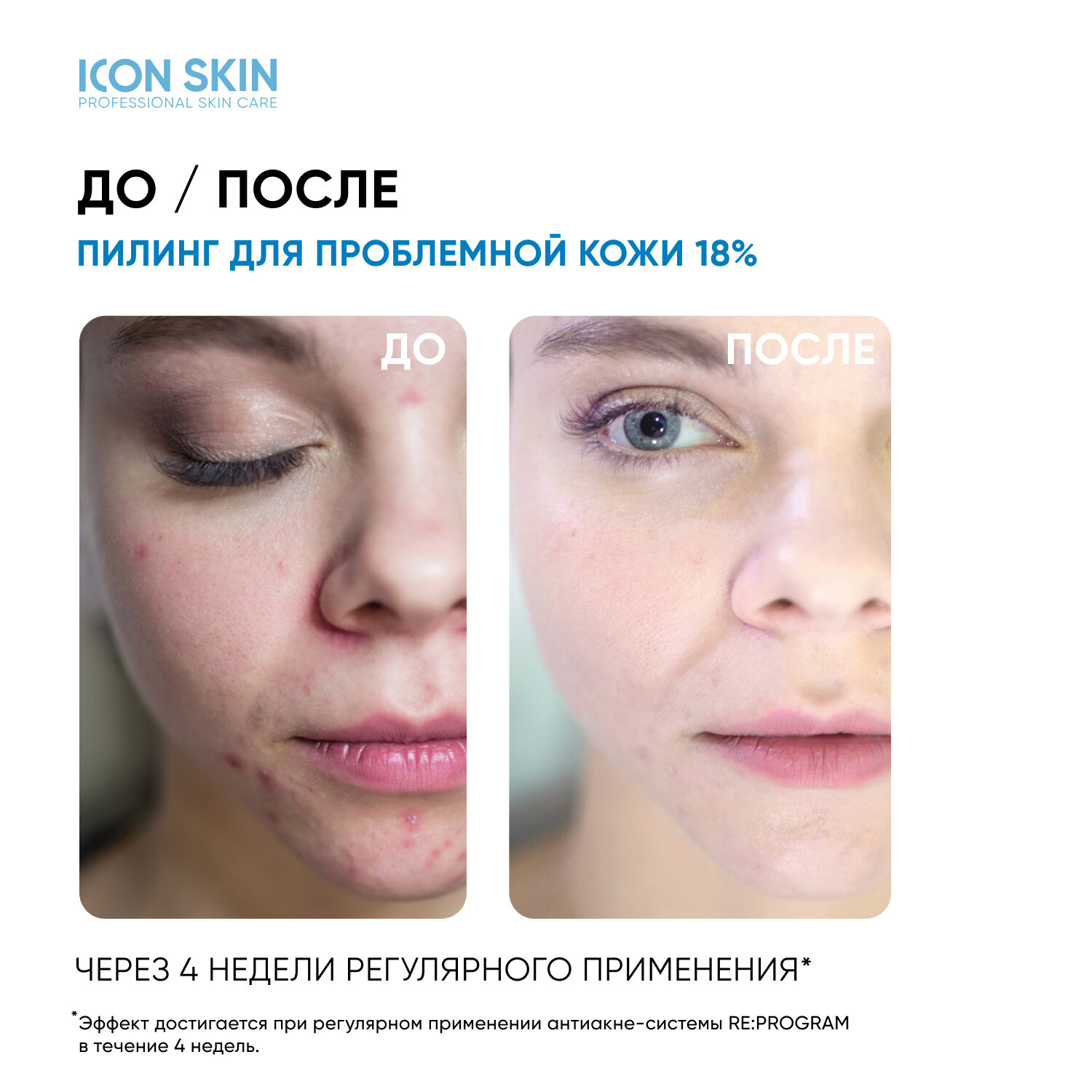 ICON SKIN / 18% Смарт пилинг-система для проблемной кожи / 18% Anti-acne Smart Peel System, 30 мл.