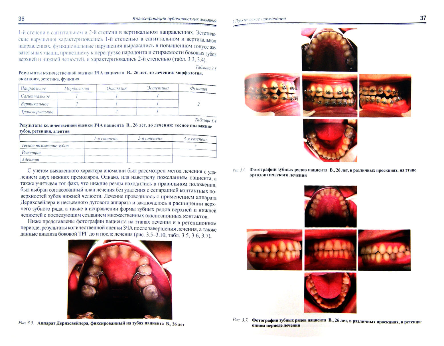 Классификации зубочелюстных аномалий. Система количественной оценки зубочелюстно-лицевых аномалий - фото №2