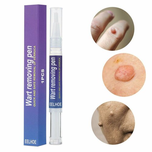Средство для удаления бородавок на коже 5 мл ручка для удаления бородавок безболезненное средство для удаления бородавок жидкая ручка для удаления бородавок кондилом остроконечных кондилом средство для удаления бородавок на ногах и ногах 888₽