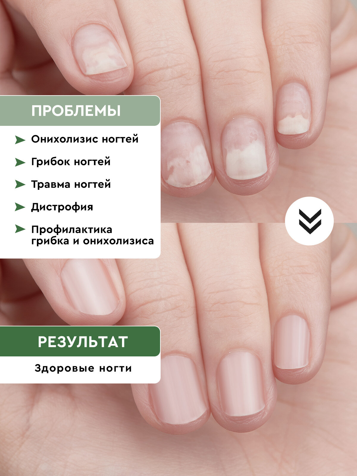 Противогрибковые Препараты Для Ногтей Бальзам для ногтей Стоп Онихолизис Инки средство для лечения 35 мл