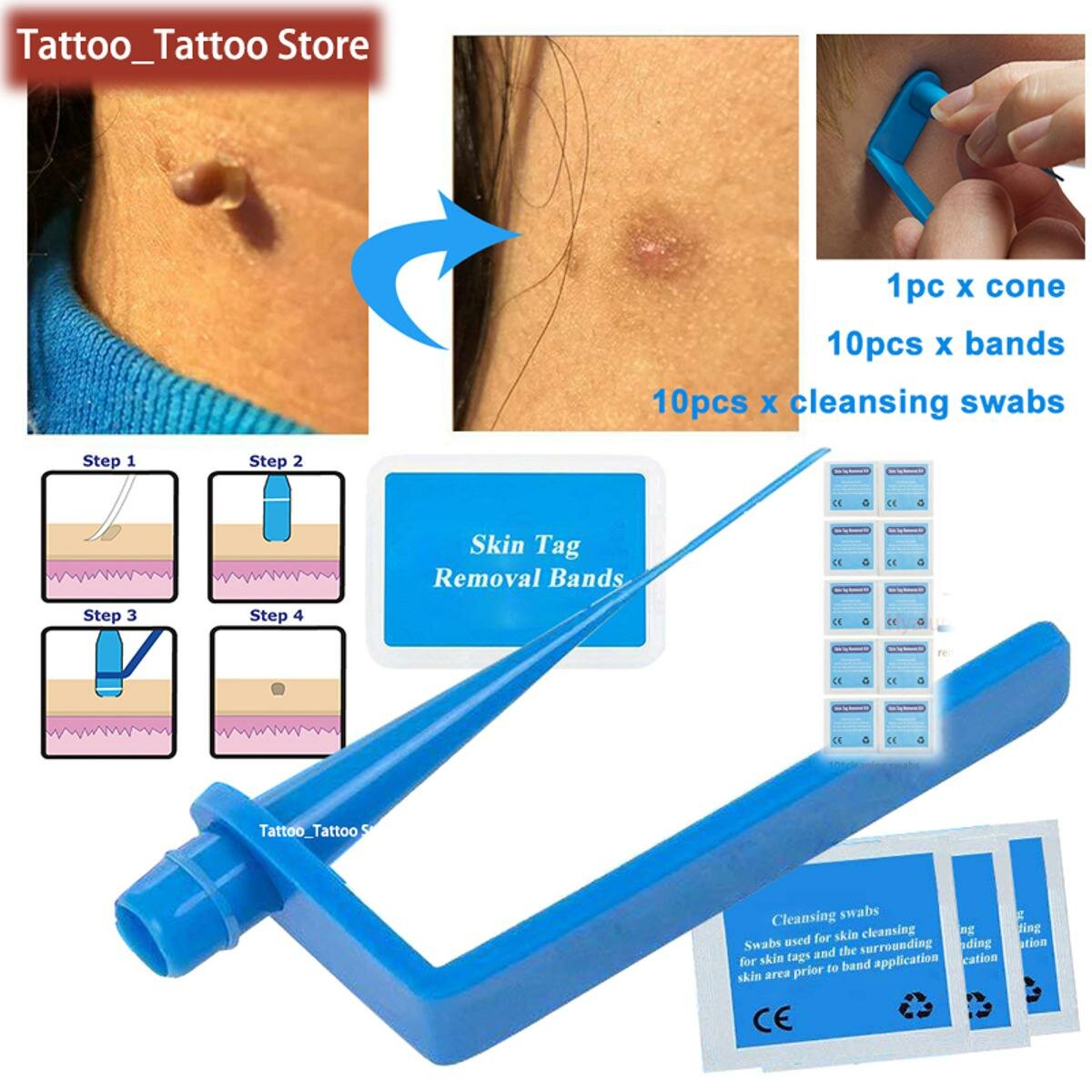 Remover Medical Micro Skin Tag Remover - Средство для удаления бородавок и родинок на коже, набор для удаления микрополосок на коже с очищающими тампонами, для взрослых родинок