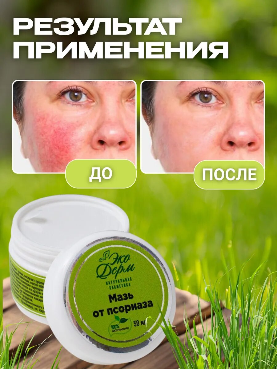 Изображение Мазь крем от псориаза и дерматита