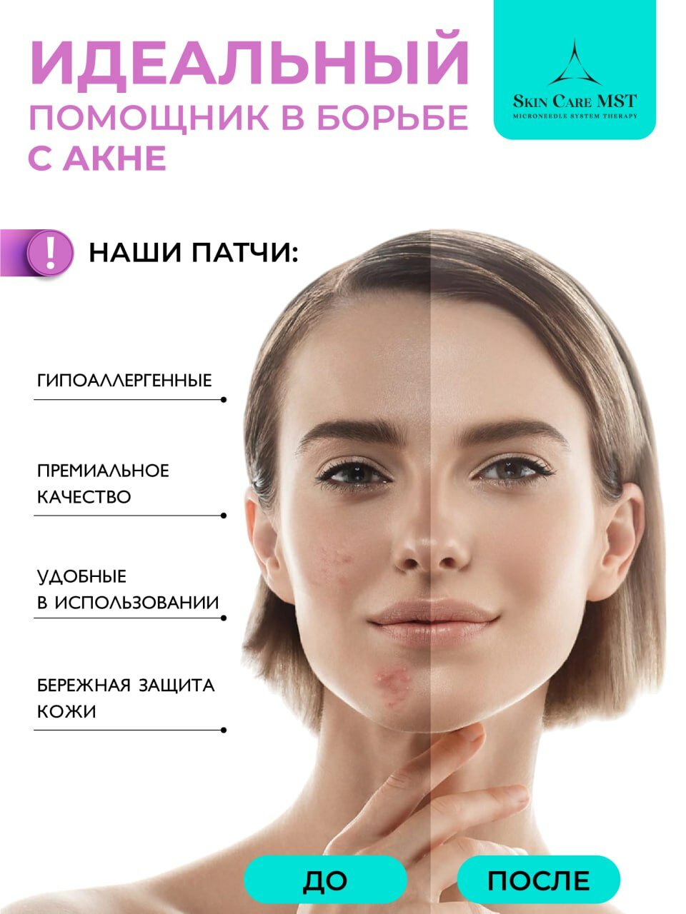 Патчи от прыщей прозрачные маскирующие салициловая кислота — фото 1