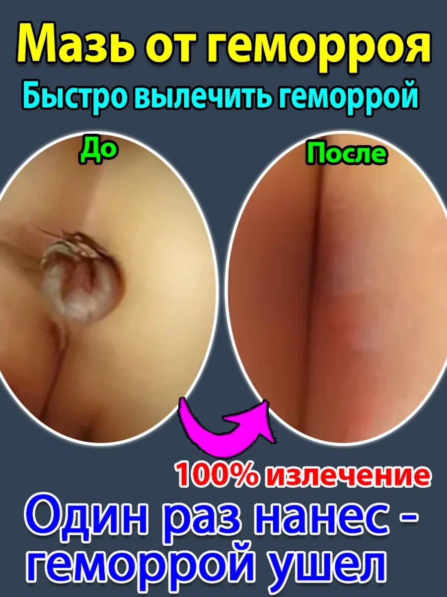 Мазь от геморроя китайская и трещин 20 грамм