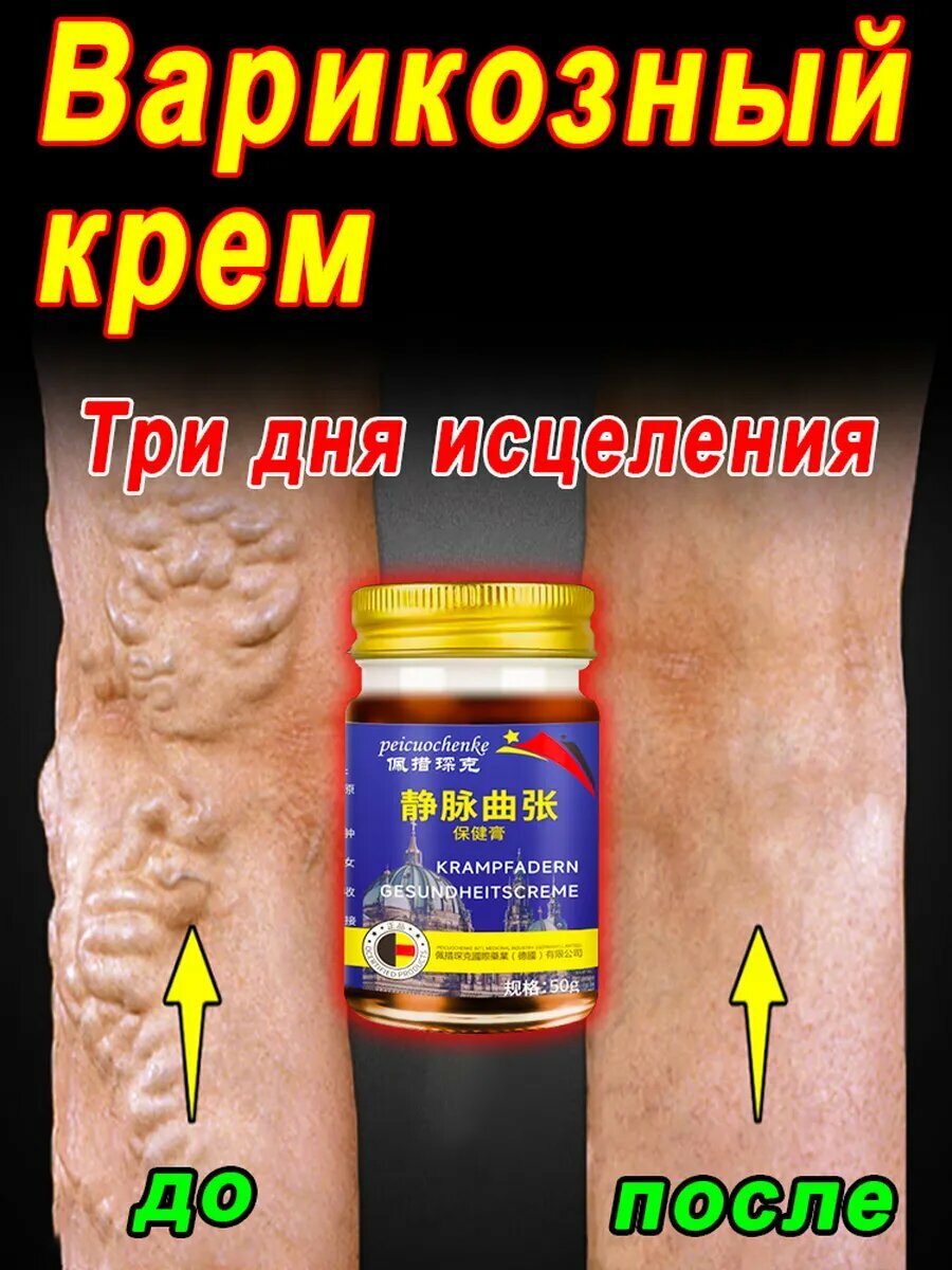 От варикоза