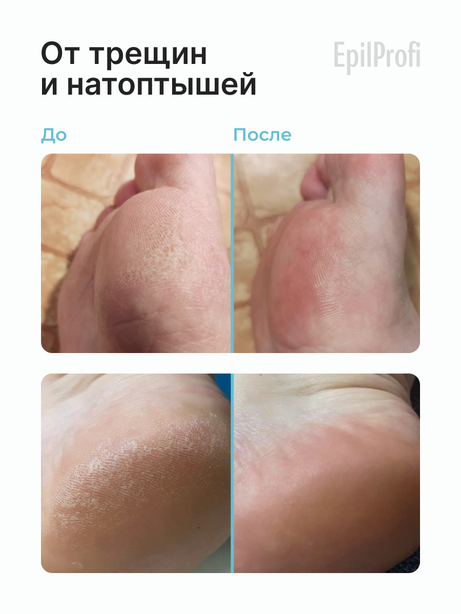 Картинки Крем для ног EpilProfi с мочевиной от трещин и натоптышей с витамином Е, F, 500 мл