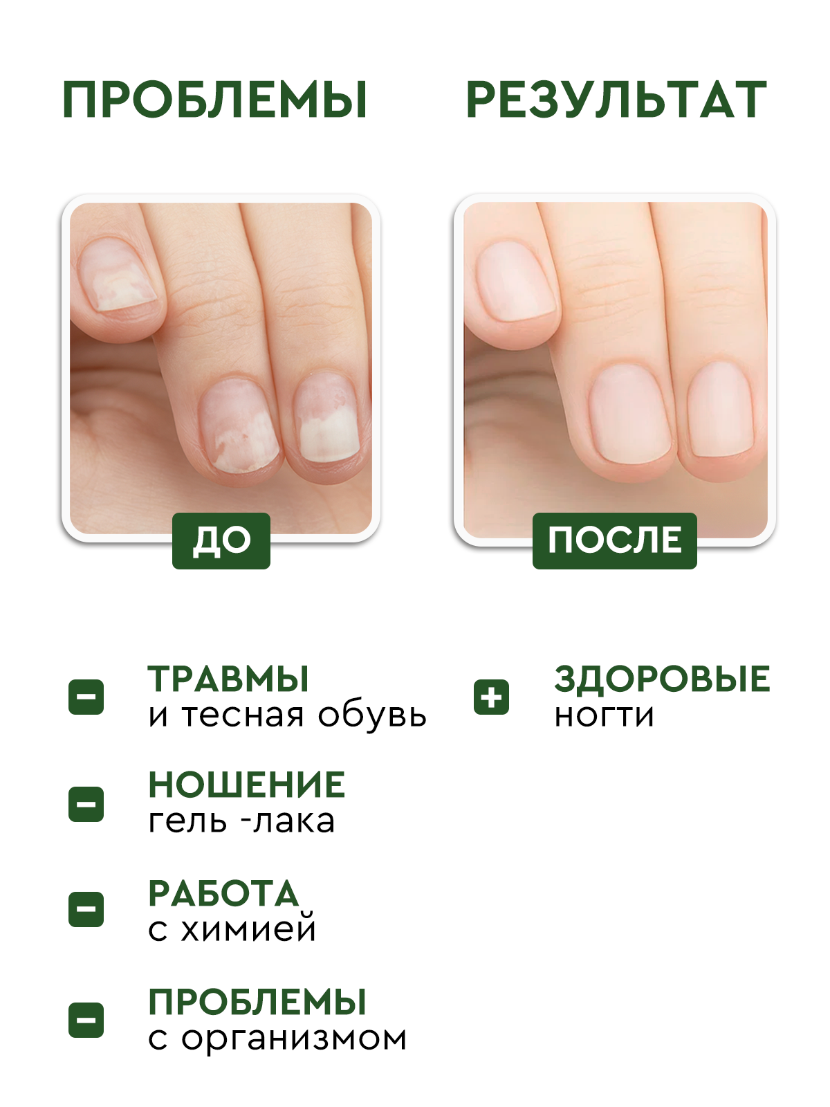 Сыворотка для ногтей INKI "Стоп Онихолизис" против отслоения, 30 мл — фото 1
