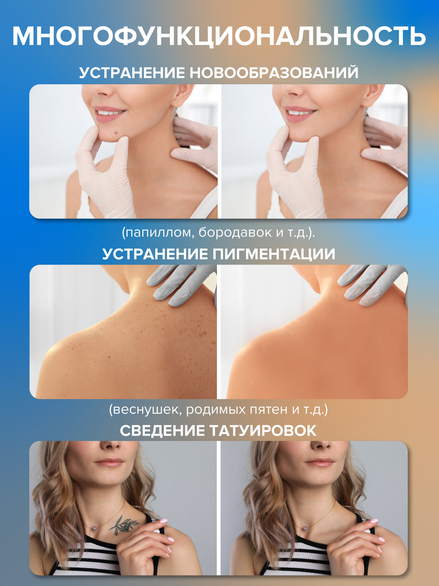 Плазменный коагулятор Evo Beauty для удаления папиллом, родинок, тату. Плазменная ручка косметологический аппарат — фото 1