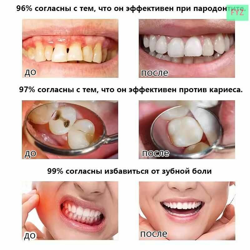 Изображение Спрей против зубной боли 20 мл для обезболивания и снятие отека при зубной боли при воспалении десен прорезывании зубов мудрости и кариесе