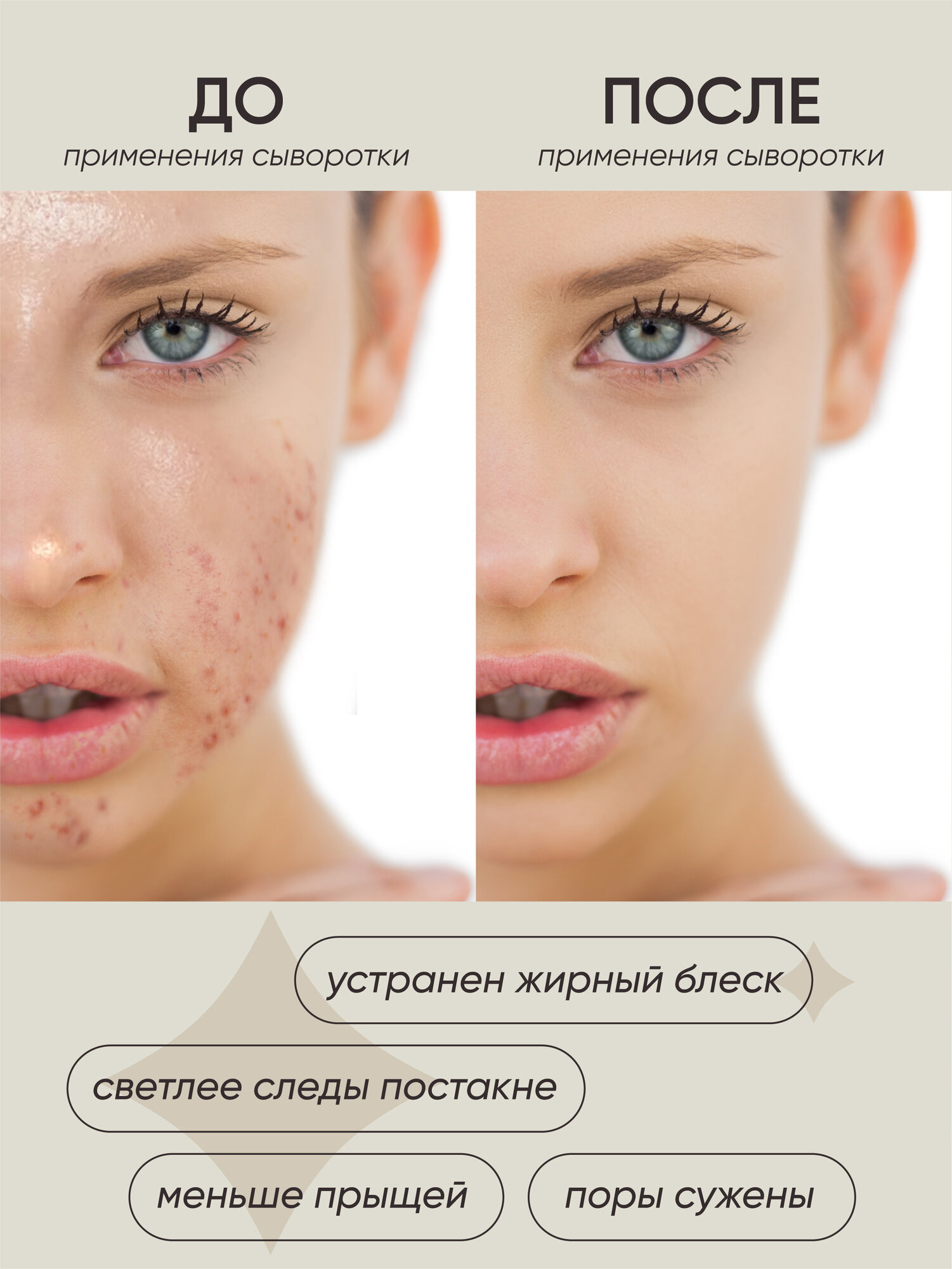 Сыворотки Для Лица Сыворотка для лица BELLUS BEAUTY от прыщей и несовершенств, с азелаиновой кислотой и ниацинамидом